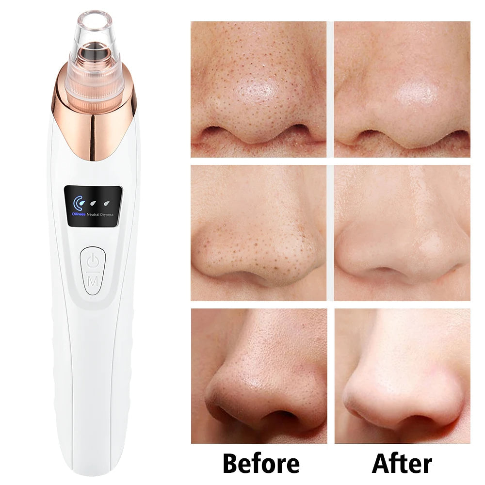 Blackhead Remover Pore Vacuum